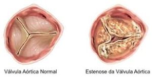 estenose aortica